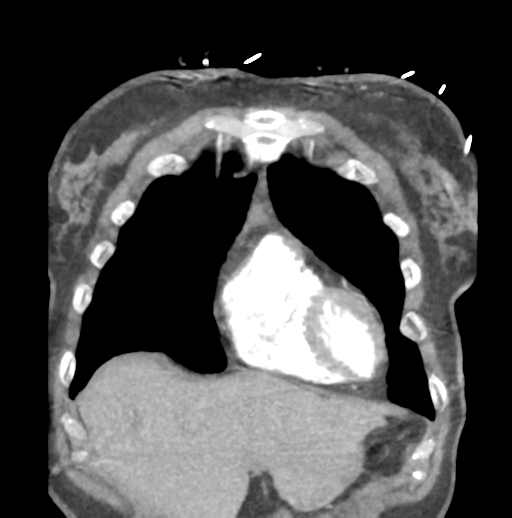 File:Aortic dissection - Stanford type B (Radiopaedia 50171-55512 B 18).png