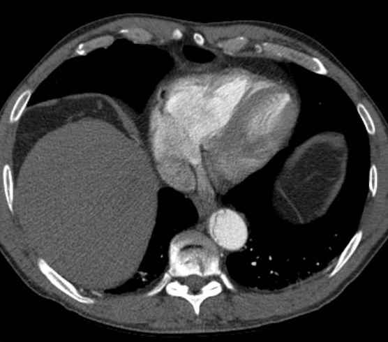 Aortic dissection - Stanford type B (Radiopaedia 73648-84437 A 88).jpg