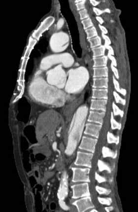 File:Aortic dissection - Stanford type B (Radiopaedia 73648-84437 C 75).jpg