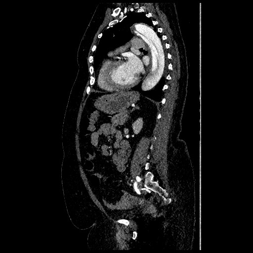 Aortic dissection - Stanford type B (Radiopaedia 88281-104910 C 54).jpg