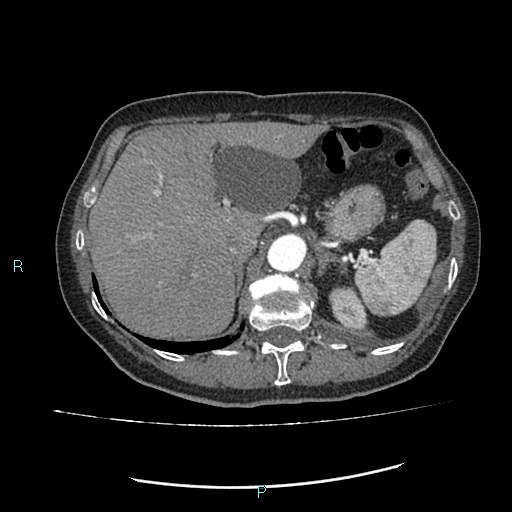 File:Aortic dissection extended to lusory artery (Radiopaedia 43686-47136 B 14).jpg