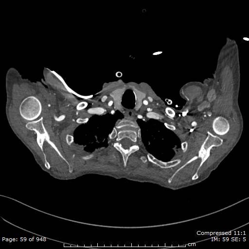File:Aortic dissection with extension into aortic arch branches (Radiopaedia 64402-73204 B 59).jpg
