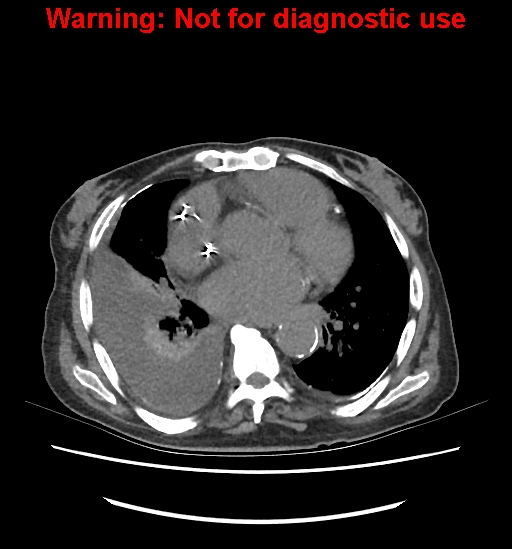 File:Aortic graft infection (Radiopaedia 44979-48907 Axial non-contrast 5).jpg