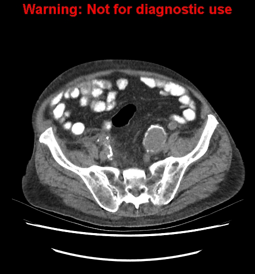File:Aortic graft infection (Radiopaedia 44979-48907 Axial non-contrast 73).jpg