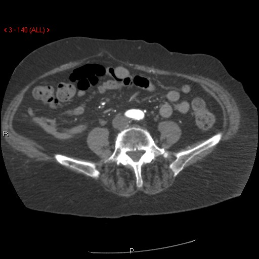 File:Aortic intramural hematoma (Radiopaedia 27746-28001 A 140).jpg
