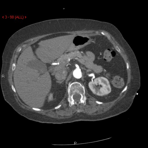 Aortic intramural hematoma (Radiopaedia 27746-28001 A 98).jpg