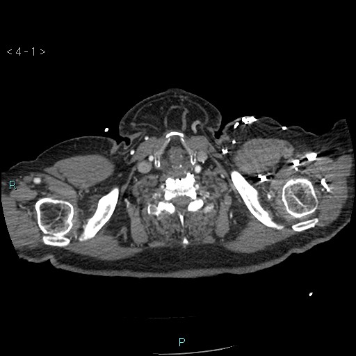 File:Aortic intramural hematoma (Radiopaedia 48463-53380 B 1).jpg
