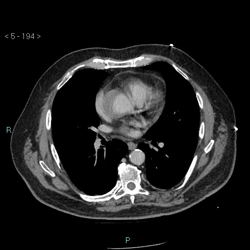 Aortic intramural hematoma (Radiopaedia 48463-53380 C 88).jpg
