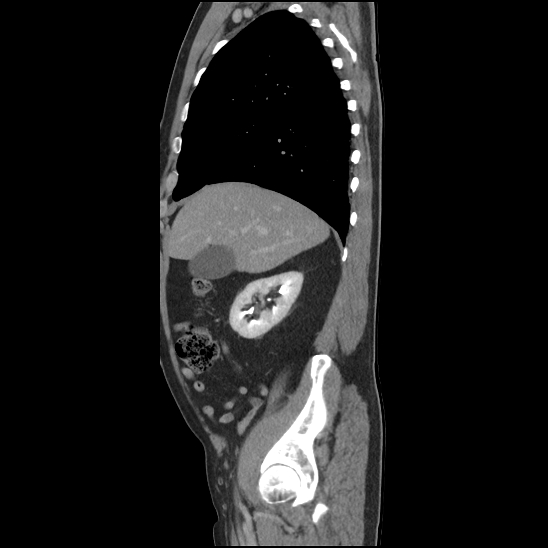 Aortic intramural hematoma (type B) (Radiopaedia 79323-92387 Sagittal C+ delayed 9).jpg