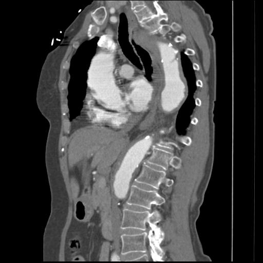 File:Aortic intramural hematoma from penetrating atherosclerotic ulcer (Radiopaedia 31137-31836 B 21).jpg