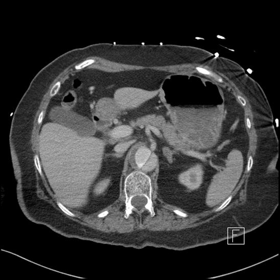 File:Aortic intramural hematoma with dissection and intramural blood pool (Radiopaedia 77373-89491 E 13).jpg