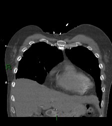 Aortic valve endocarditis (Radiopaedia 87209-103485 D 56).jpg