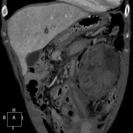 File:Aorto-left renal vein fistula (Radiopaedia 45534-49628 B 5).jpg