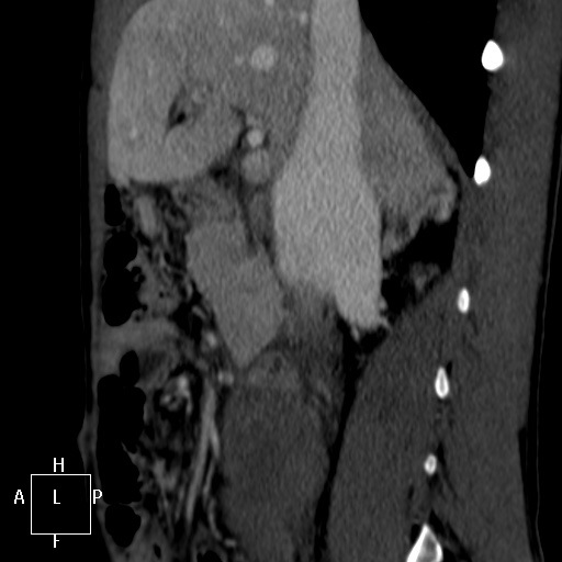 File:Aorto-left renal vein fistula (Radiopaedia 45534-49628 C 15).jpg