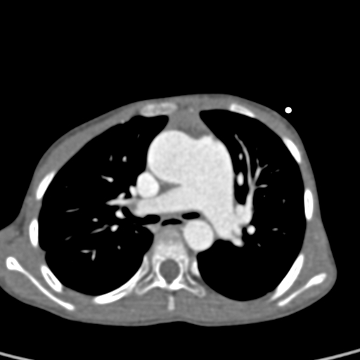 File:Aortopulmonary window, interrupted aortic arch and large PDA giving the descending aorta (Radiopaedia 35573-37074 B 35).jpg