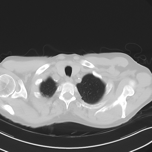 Apical pulmonary metastasis (Radiopaedia 46338-50754 Axial non-contrast 9).png