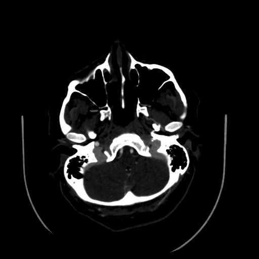 Aplasia of the internal carotid artery (Radiopaedia 61082-68960 A 13).jpg