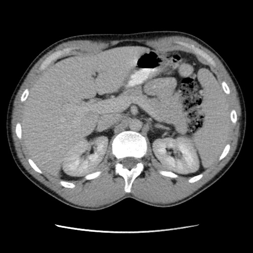 Appendicitis complicated by post-operative collection (Radiopaedia 35595-37113 A 19).jpg
