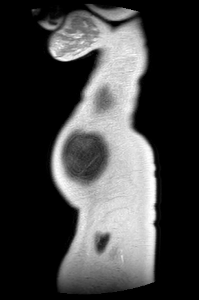 Appendicitis in gravida (MRI) (Radiopaedia 89433-106395 Sagittal T2 3).jpg