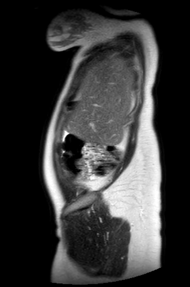 Appendicitis in gravida (MRI) (Radiopaedia 89433-106395 Sagittal T2 58).jpg