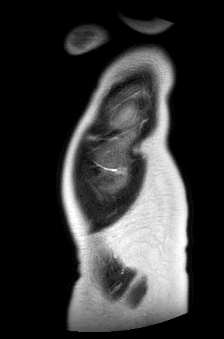 Appendicitis in gravida (MRI) (Radiopaedia 89433-106395 Sagittal T2 61).jpg