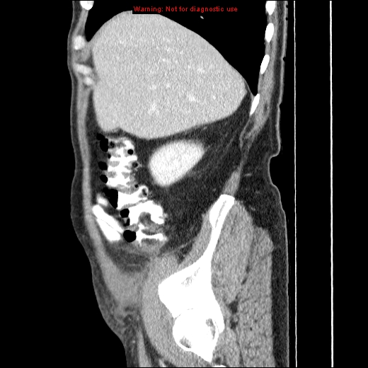 File:Appendicitis mass in inguinal hernia (Radiopaedia 26858-27029 C 9).jpg