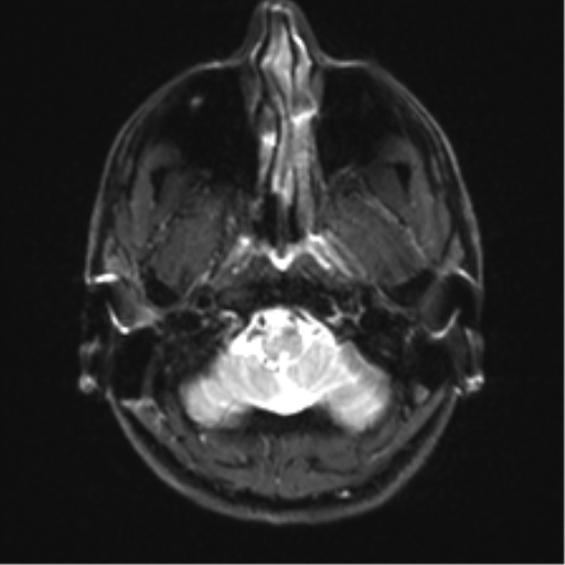 Arachnoid cyst - cerebellopontine angle (Radiopaedia 59689-67083 Axial DWI 4).png