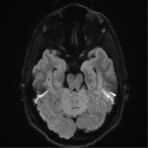 Arachnoid cyst - cerebellopontine angle (Radiopaedia 59689-67083 Axial DWI 49).png