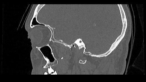 Arcuate foramen (Radiopaedia 89833-106944 Sagittal bone window 115).jpg