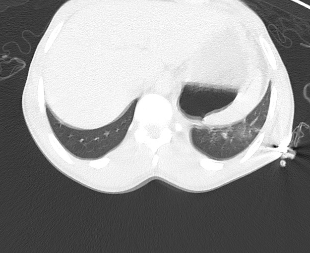 File:Arrow injury to the chest (Radiopaedia 75223-86321 Axial lung window 92).jpg