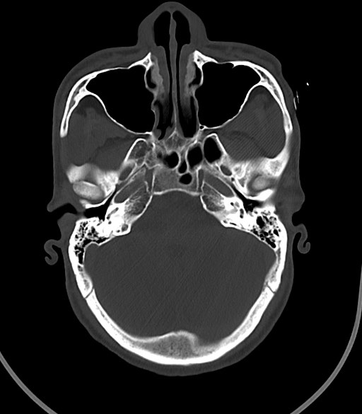 Arrow injury to the face (Radiopaedia 73267-84011 Axial bone window 46).jpg