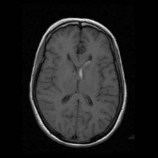 File:Arteriovenous malformation (cerebral) (Radiopaedia 40070-42580 Axial T1 12).png