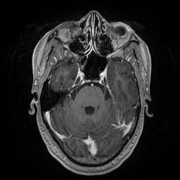 File:Artery of Percheron infarction (Radiopaedia 27975-28230 Axial T1 C+ fat sat 30).jpg