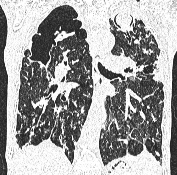 Aspergilloma- with Monod sign (Radiopaedia 44737-48532 Coronal lung window 275).jpg