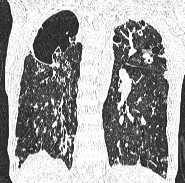 Aspergilloma- with Monod sign (Radiopaedia 44737-48532 Coronal lung window 320).jpg
