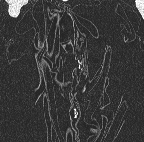 Aspergilloma- with Monod sign (Radiopaedia 44737-48532 Coronal lung window 84).jpg