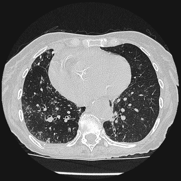 Aspergilloma (Radiopaedia 24458-24763 Axial lung window 46).jpg