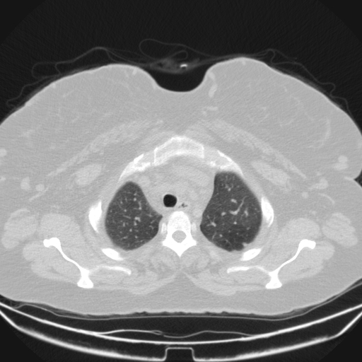 Aspergilloma (Radiopaedia 39611-41932 Axial lung window 17).jpg