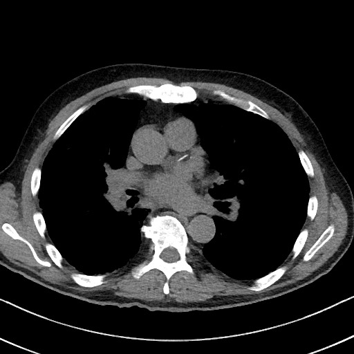 File:Aspergilloma on background pulmonary fibrosis (Radiopaedia 60942-68757 Axial non-contrast 31).jpg