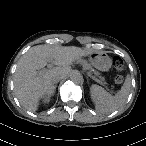 Aspergilloma on background pulmonary fibrosis (Radiopaedia 60942-68757 Axial non-contrast 56).jpg