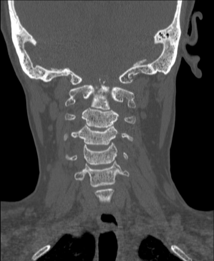 Atlanto-occipital assimilation with basilar invagination (Radiopaedia 70122-80188 Coronal bone window 106).jpg