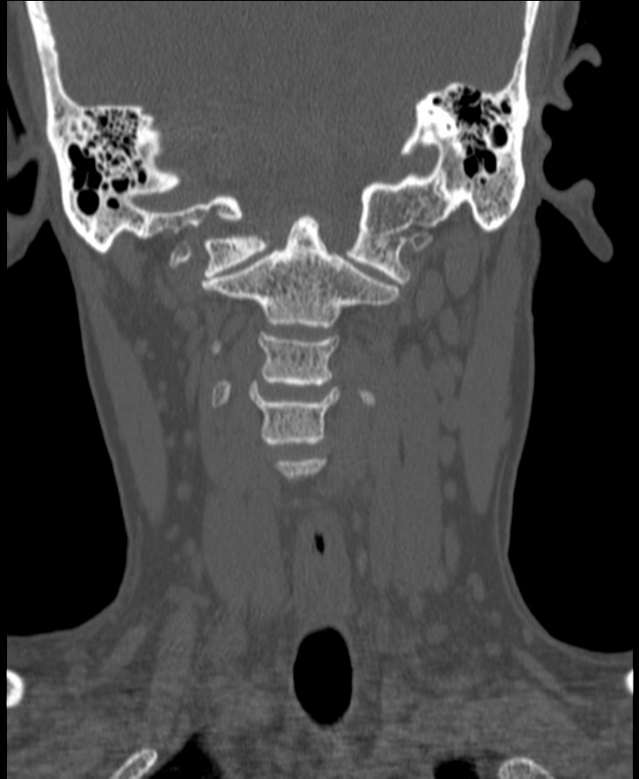 Atlanto-occipital assimilation with basilar invagination (Radiopaedia 70122-80188 Coronal bone window 81).jpg