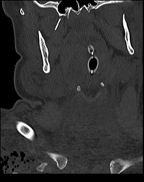 Atlanto-occipital dissociation - Traynelis type 1 (Radiopaedia 87570-103948 Coronal bone window 11).jpg