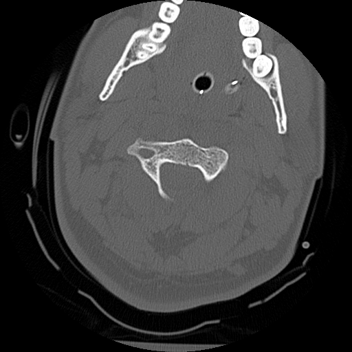 Atlanto-occipital dissociation injury (Radiopaedia 29274-29698 Axial bone window 22).png