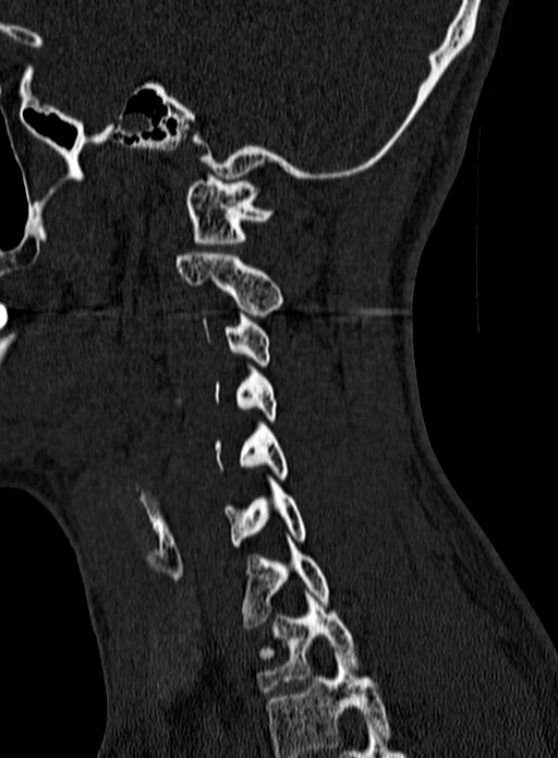 Atlantoaxial subluxation (Radiopaedia 44681-48450 Sagittal bone window 126).jpg
