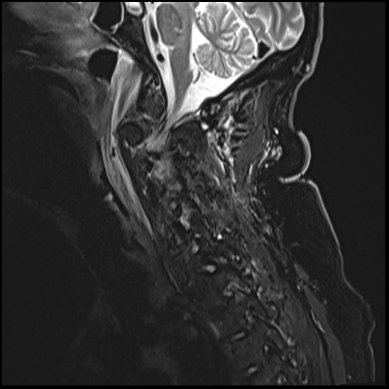 File:Atlas (type 3b subtype 1) and axis (Anderson and D'Alonzo type 3, Roy-Camille type 2) fractures (Radiopaedia 88043-104610 Sagittal STIR 3).jpg