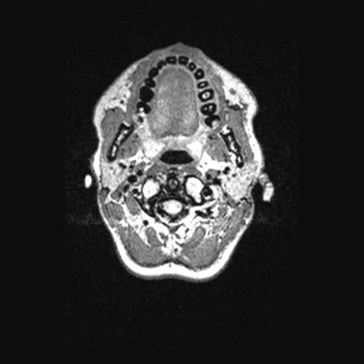 Atretic encephalocoele with inferior vermis hypoplasia (Radiopaedia 30443-31108 Axial 9).jpg