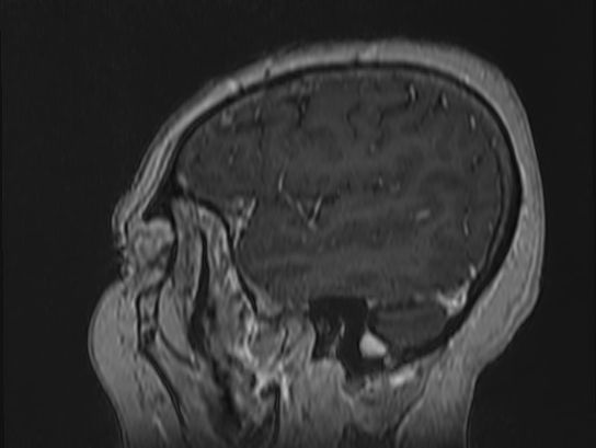 Atypical meningioma (Radiopaedia 62985-71406 Sagittal T1 C+ 11).jpg
