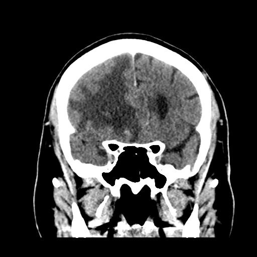 Atypical meningioma (WHO grade II) with brain invasion (Radiopaedia 57767-64728 Coronal C+ 22).png