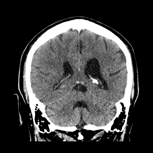 Atypical meningioma (WHO grade II) with brain invasion (Radiopaedia 57767-64728 Coronal C+ 42).png